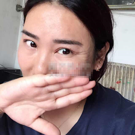 注射注射瘦臉去魚尾紋前后對比果照片分享，大同清木姜際珠做的~