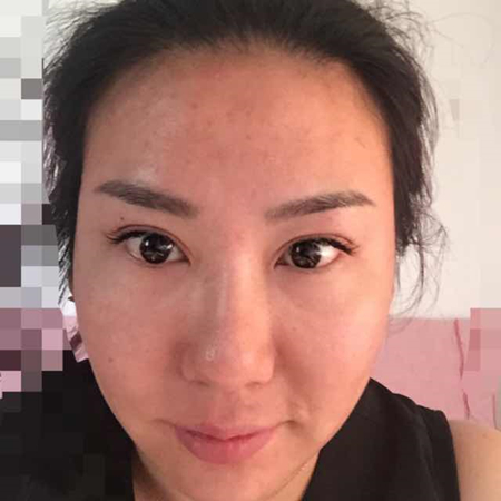 注射注射瘦臉去魚尾紋前后對比果照片分享，大同清木姜際珠做的~