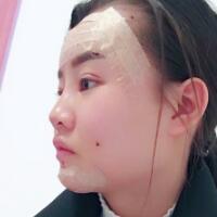 自體脂肪面部填充恢復過程分享，填充價格12000元