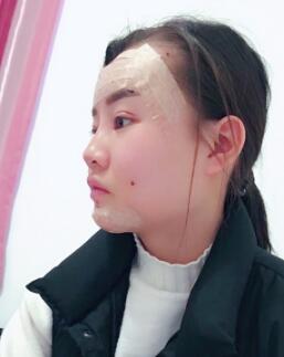 自體脂肪面部填充整形果圖