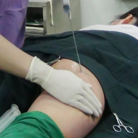 自體脂肪面部填充后我不再依賴(lài)p圖軟件了