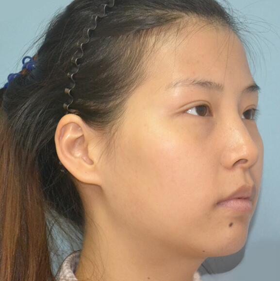 自體脂肪面部填充后我不再依賴(lài)p圖軟件了