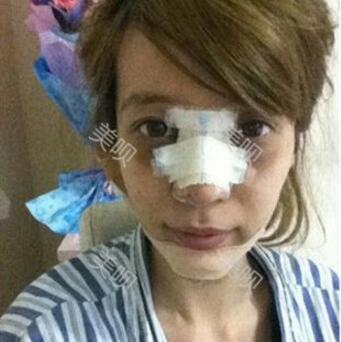 我的自體脂肪隆鼻+墊下巴恢復(fù)過(guò)程