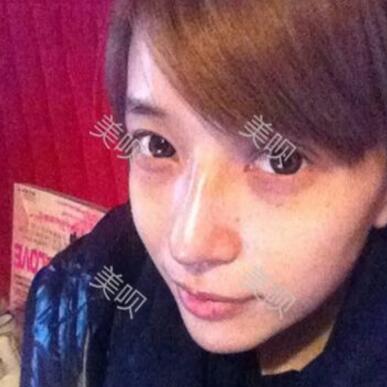 我的自體脂肪隆鼻+墊下巴恢復(fù)過(guò)程