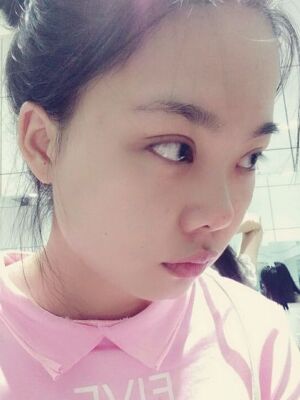 全切雙眼皮手術(shù)，送給自己的成年禮物