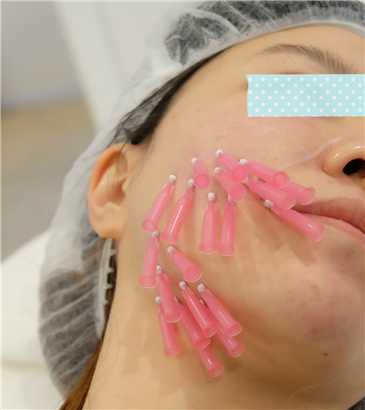 面部埋埋蛋白線.提升術(shù)后恢復(fù)過(guò)程分享，還有前后對(duì)比果照片哦~