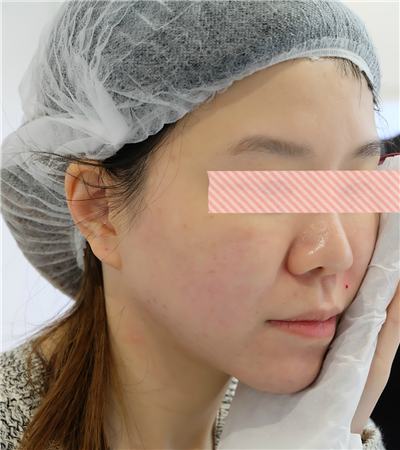 面部埋埋蛋白線.提升術(shù)后恢復(fù)過(guò)程分享，還有前后對(duì)比果照片哦~