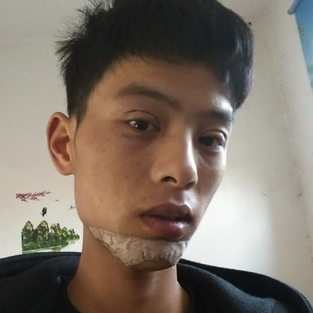 內(nèi)切去眼袋+切開(kāi)割雙眼皮恢復(fù)過(guò)程和前后對(duì)比果圖片分享哦~