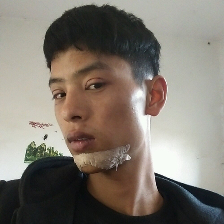 內(nèi)切去眼袋+切開(kāi)割雙眼皮恢復(fù)過(guò)程和前后對(duì)比果圖片分享哦~