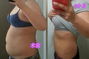 吸脂減肥手術(shù)前后果對(duì)比圖