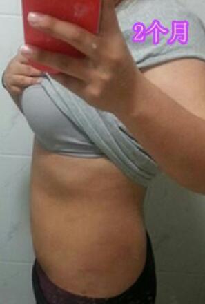 吸脂減肥2個(gè)多月了，果很滿意