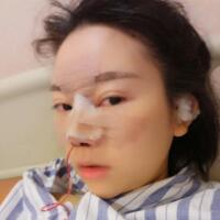鼻子整形價格10000元，隆鼻手術(shù)過程圖分享