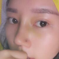 鼻子整形價格10000元，隆鼻手術(shù)過程圖分享