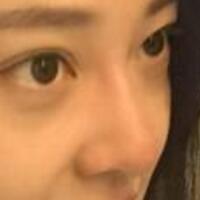 為什么大家覺得隆鼻恐怖，我就做了玻尿酸隆鼻，過程經(jīng)歷分享