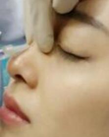 玻尿酸隆鼻手術(shù)分享
