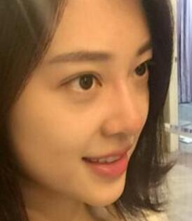 玻尿酸隆鼻手術(shù)下臺后的照片