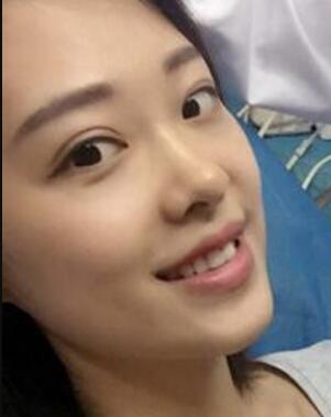 玻尿酸隆鼻手術(shù)