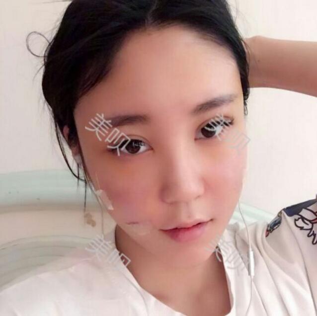 自體脂肪豐蘋果肌后我凹陷顯老的面部終于變得年輕啦