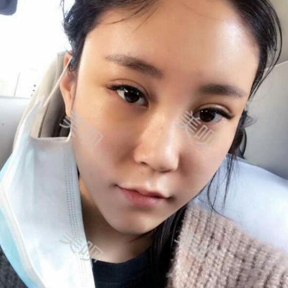 自體脂肪豐蘋果肌后我凹陷顯老的面部終于變得年輕啦