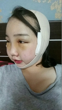 顴骨整形手術(shù)后，我也可以擁有精致小臉了