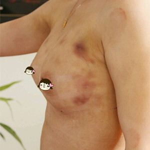 深圳美源做的自體脂肪隆胸，大家來看看果如何?