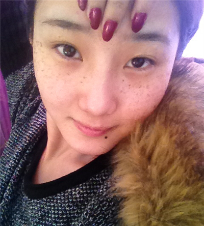 激光去雀斑+華爾茲冰點(diǎn)脫全身毛術(shù)后恢復(fù)過(guò)程照片分享~~