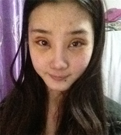 激光去雀斑+華爾茲冰點(diǎn)脫全身毛術(shù)后恢復(fù)過(guò)程照片分享~~