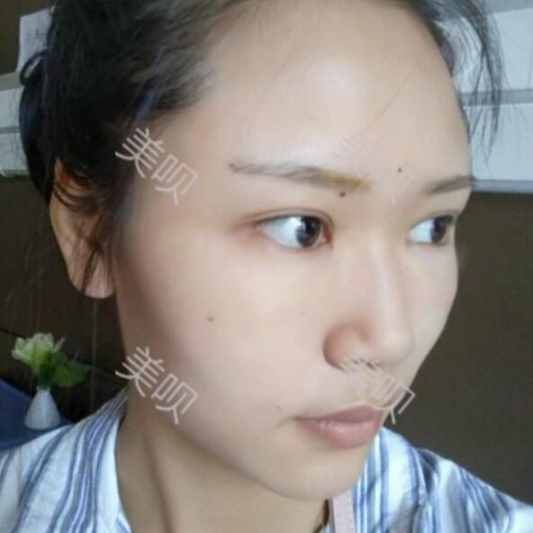 自體脂肪面部填充后臉上有膠原蛋白的感覺真爽