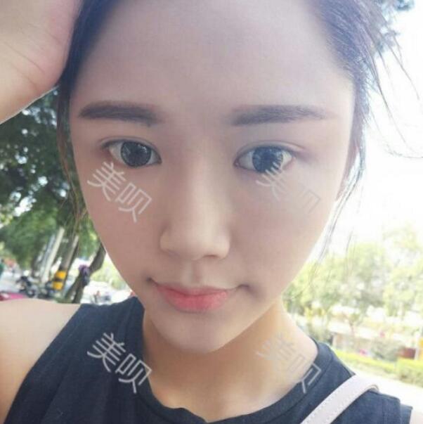 自體脂肪面部填充后臉上有膠原蛋白的感覺真爽