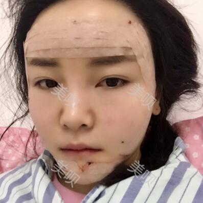 自體脂肪面部填充40天的恢復過程給大家做個參考