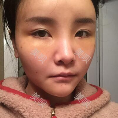 自體脂肪面部填充40天的恢復過程給大家做個參考