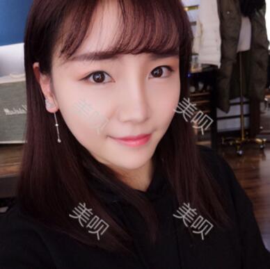 自體脂肪面部填充40天的恢復過程給大家做個參考