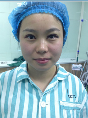 開內(nèi)眼角+雙眼皮手術(shù)后，我也變成大眼睛妹紙了