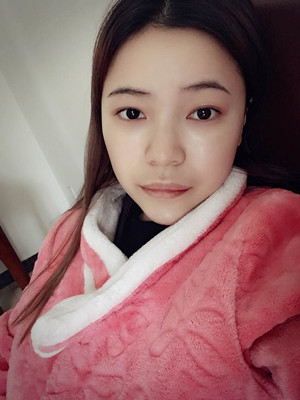 去年12月做的自體脂肪填充蘋果肌，大家來看看果怎么樣?