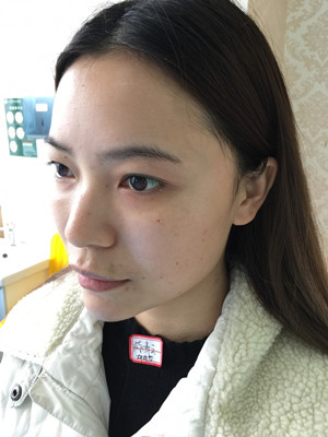 去年12月做的自體脂肪填充蘋果肌，大家來看看果怎么樣?