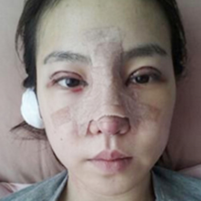 隆鼻整形+切開雙眼皮三個月恢復照片分享，莆田維納斯做的~