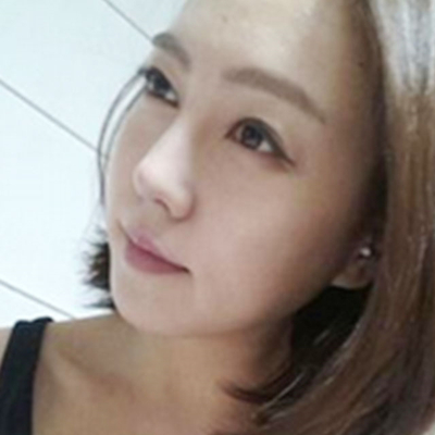 隆鼻整形+切開雙眼皮三個月恢復照片分享，莆田維納斯做的~