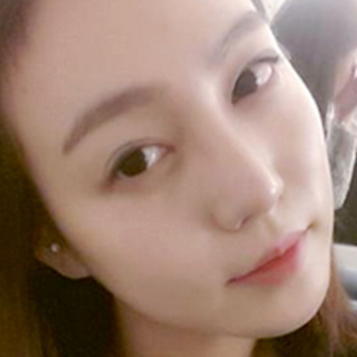 隆鼻整形+切開雙眼皮三個月恢復照片分享，莆田維納斯做的~