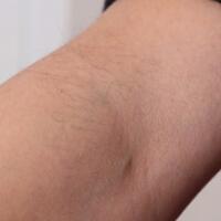 從小我就毛發(fā)旺盛，做了激光脫毛果圖分享給大家