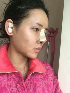自體軟骨隆鼻+自體脂肪豐蘋(píng)果肌，成功逆襲成女神