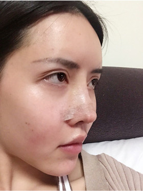 自體軟骨隆鼻+自體脂肪豐蘋(píng)果肌，成功逆襲成女神