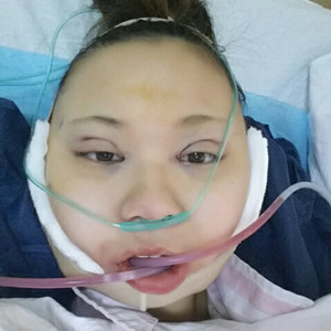 切開(kāi)雙眼皮+磨下頜角，記錄了手術(shù)前后的過(guò)程，給大家分享一下