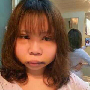 切開(kāi)雙眼皮+磨下頜角，記錄了手術(shù)前后的過(guò)程，給大家分享一下