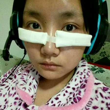 激光去眼袋半個(gè)月了，分享恢復(fù)照片，果棒棒的~~