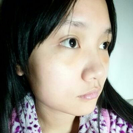 激光去眼袋半個(gè)月了，分享恢復(fù)照片，果棒棒的~~