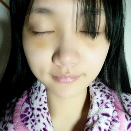 激光去眼袋半個(gè)月了，分享恢復(fù)照片，果棒棒的~~