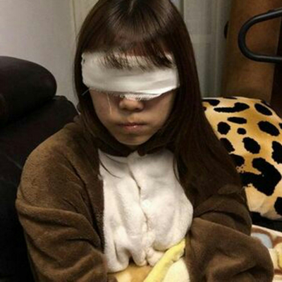 開(kāi)內(nèi)眼角+切開(kāi)割雙眼皮兩個(gè)月了，分享術(shù)后恢復(fù)過(guò)程照片~