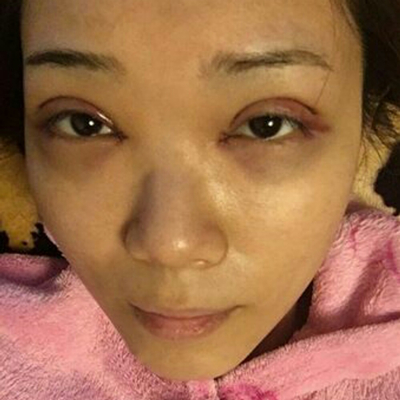 開(kāi)內(nèi)眼角+切開(kāi)割雙眼皮兩個(gè)月了，分享術(shù)后恢復(fù)過(guò)程照片~