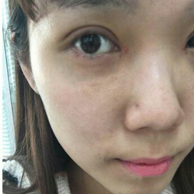 開(kāi)內(nèi)眼角+切開(kāi)割雙眼皮兩個(gè)月了，分享術(shù)后恢復(fù)過(guò)程照片~