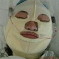 做了磨下頜角手術(shù)一年了，手術(shù)費用為16800元，已經(jīng)完全恢復(fù)